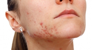 REVISE: Galderma To Meet with FDA About Rx-to-OTC Acne Switch 