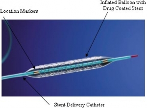Less Efficacy Than Expected in Largest Drug-Eluting Stent Trial