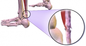 Nonsurgical and Surgical Treatments Show Successful Outcomes for Achilles Tear