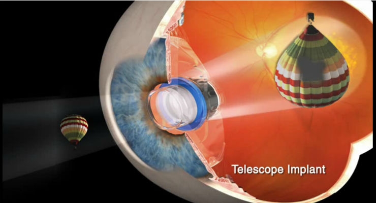 VisionCare to Initiate Clinical Study of Telescope Implant in Post-Cataract Patients
