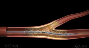 FDA Approval for Tryton Side Branch Stent 