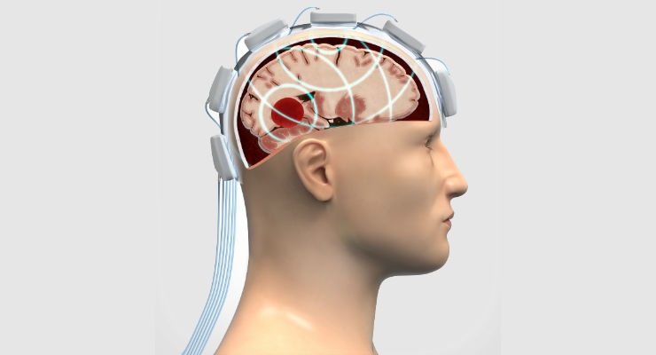 Microwave Helmet Yields Fast, Safe Head Injury Evaluation