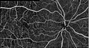 Optovue First to Release High Density OCT Angiography for Ophthalmology 