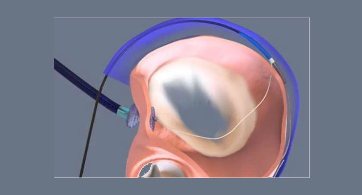 Clinical Trials Show Promise for Less-Invasive Therapy to Help With Mitral Valve Regurgitation