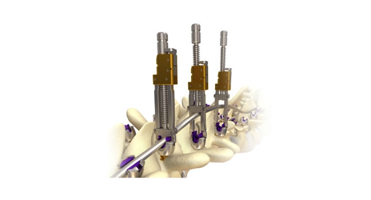 K2M Launches New Surgical Solutions to Enhance MESA 2 Deformity Spinal System