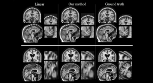 Artificial Intelligence Boosts Quality of Stroke MRI Scans