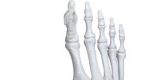 Paragon 28 Launches Nitinol Staple System for Fracture & Osteotomy Foot Fixation