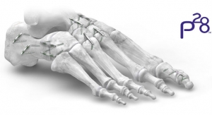 Paragon 28 Expands Nitinol Staple Offering to Midfoot and Hindfoot Correction