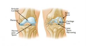 New Research Ranks the Effectiveness of Nonsurgical Treatments for Knee Osteoarthritis