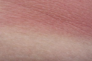 Inflammation Resolution During Skin Aging