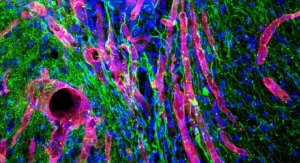 Biomaterial Could Help Regrow Brain Tissue After Stroke
