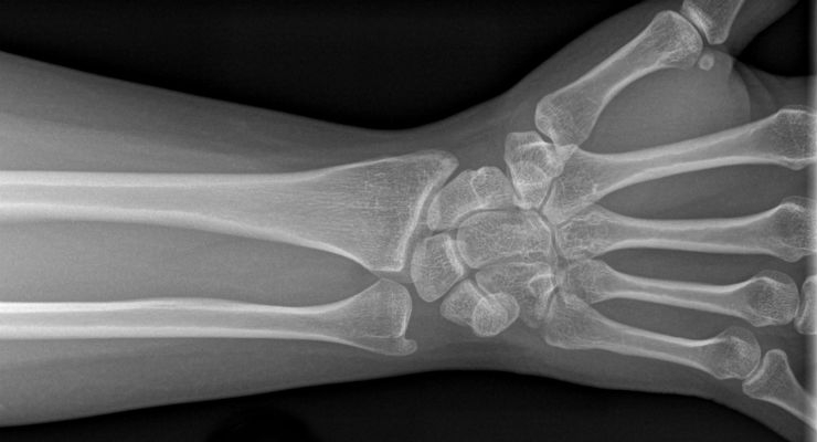 FDA OKs OsteoDetect AI-Guided Software to Spot Wrist Fractures