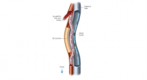 PQ Bypass Reports Positive 12-Month Results for New Procedure to Treat Extremely Long SFA Lesions