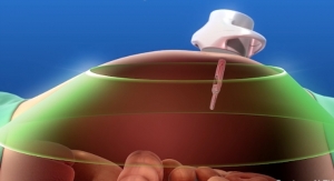 Surgeon Uses Magnetic Tools to Reduce Incisions in Cancer Surgery