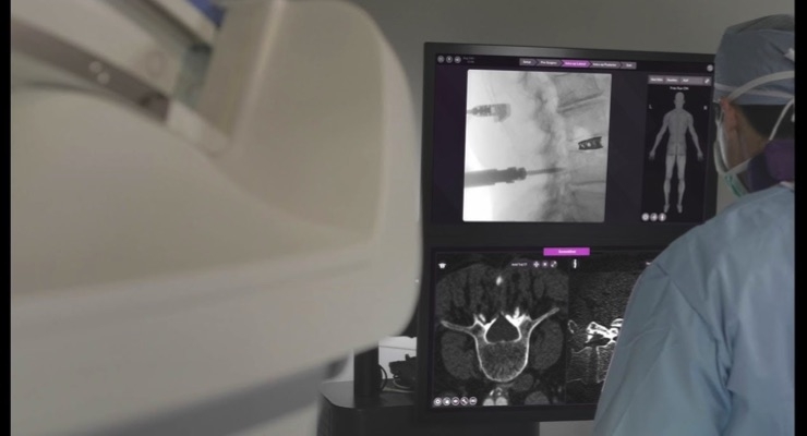 NuVasive Demonstrating Pulse Surgical Automation Platform At NASS ...