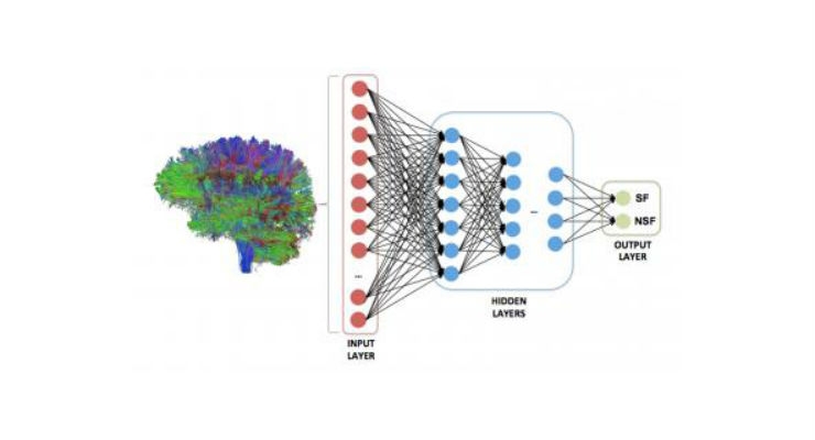 Whole-Brain Connectome Maps Teach AI to Predict Epilepsy Outcomes