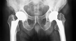 Cementless Hip Implants Are Gradually Losing Their Popularity in Europe