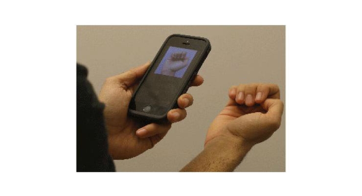 No Bleeding Required: Anemia Detection via Smartphone