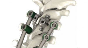 Southern Spine Launches Thoracic Dual Lamina Implants for StabiLink Interlaminar System