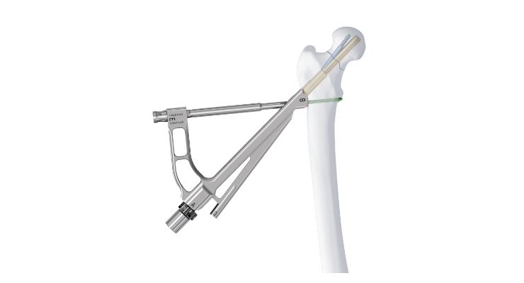 FRNADVANCED Femoral Recon Nailing System  DePuy Synthes