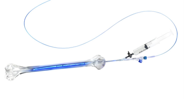 IlluminOss Bone Stabilization System Launched in U.S. for Fragility Fractures