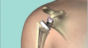AAOS News: Underweight Patients at Greatest Risk of Complications From Total Shoulder Arthroplasty