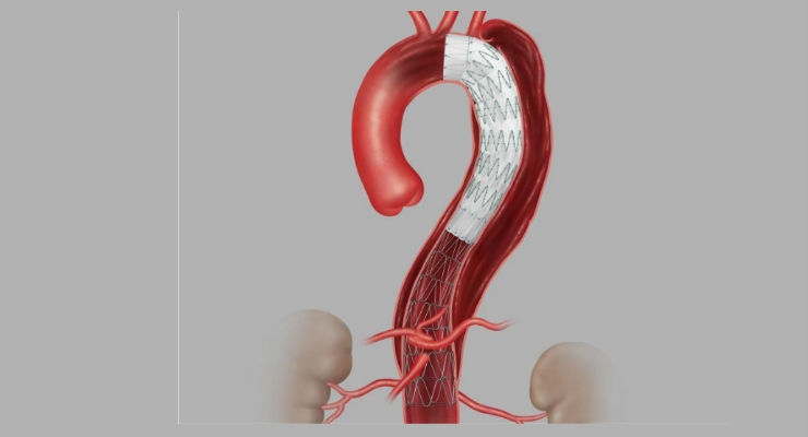 Cook Medical Receives FDA Approval for Aortic Dissection Device