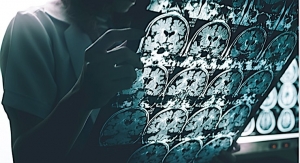 New Drug Development Strategies Needed for Alzheimer’s Treatments
