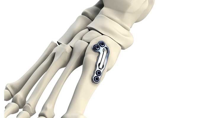 A Little Extreme: Factors Impacting the Extremities Implants Segment