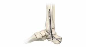 In2Bones Launches the TriWay TibioTaloCalcaneal Nail Arthrodesis System