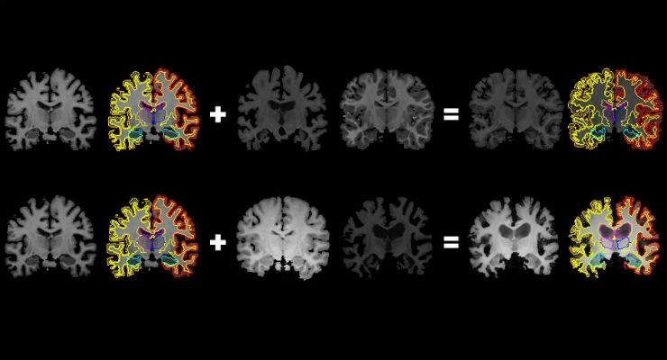 From One Brain Scan, More Info for Medical AI
