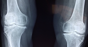AOSSM News: Study Suggests Surgery a Better Option for Older Patients with Meniscus Tears