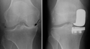 Study: Increased Partial Knee Replacement Use Could Save NHS Millions Annually