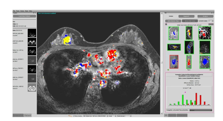 FDA-Cleared Artificial Intelligence Breast Cancer Diagnosis System Launched by Paragon Biosciences