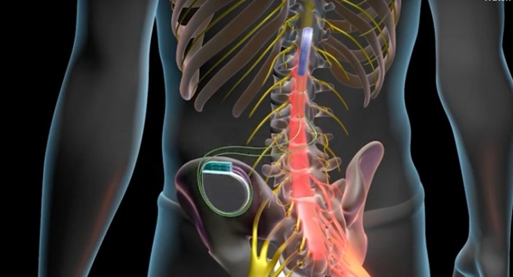 Electrical Spinal Cord Stimulation Treatment