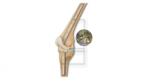 OsteoRemedies Launches the First Preformed Knee Spacer With Modular Stems
