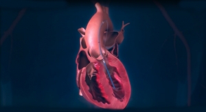 Is a Cardiac Pump the Key to Curbing Heart Failure?