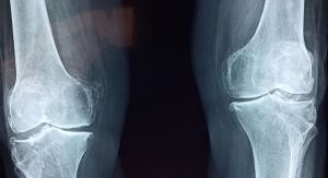 The Appealing Benefits of Anatomic Joint Preservation Arthroplasty