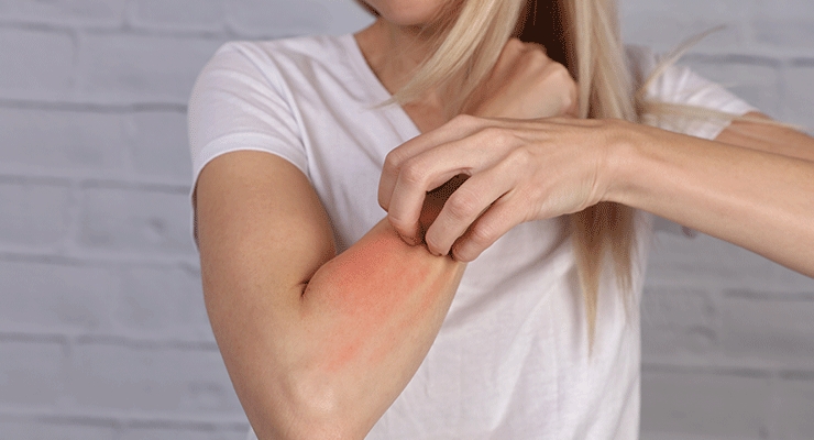 Allergy, Inflammation or Irritation?