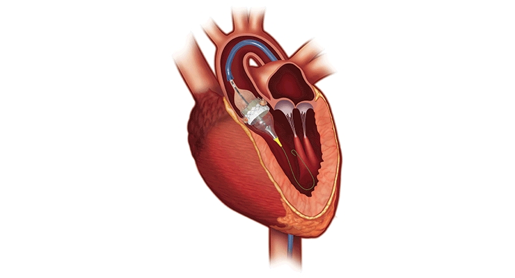Getting to the Heart of the Matter: An Examination of Transcatheter Heart Technologies