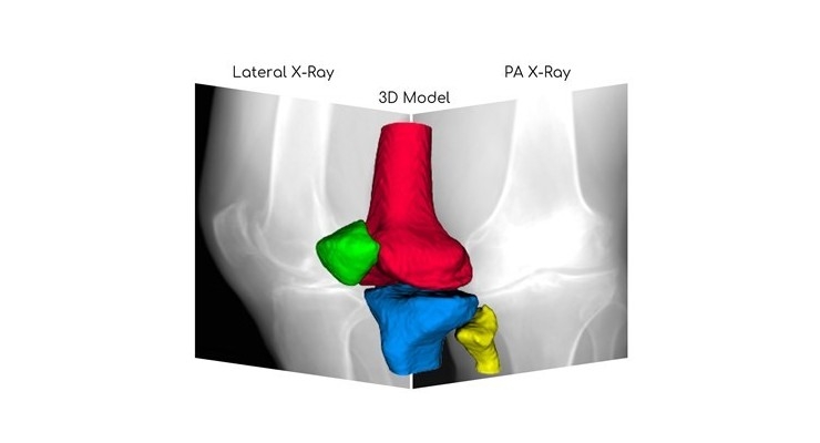 RSIP Vision Launches AI for 3D Knee Image Reconstruction