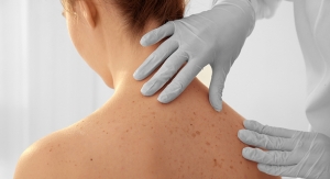 Some Good News About Melanoma