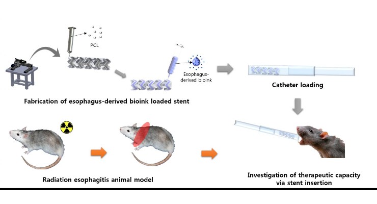 Biodegradable 3D Printed Stents Treat Esophageal Inflammation