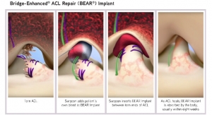 FDA OKs Miach Orthopaedics’ BEAR Implant for ACL Tears 