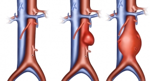 Omega-3s Improve Vascular Stiffness in Abdominal Aortic Aneurysm 