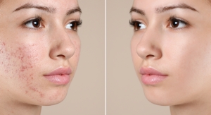 Amyris Shares Clinical Results for Clean Acne Treatment
