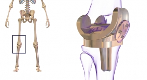 Solid Growth Predicted for Global Knee Replacement Market
