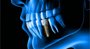 Researchers Develop AI to Predict Outcomes for Patients with Diseased Dental Implants