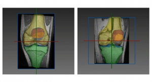RSIP Vision Unveils New Articular Cartilage Segmentation Tool
