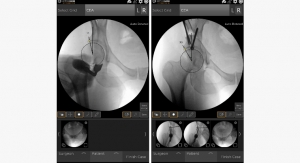 OrthoGrid Systems Launches Hip Preservation Application